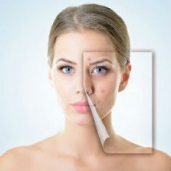 Preventing Acne Scars
